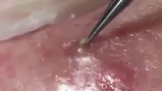 Deep BLACKHEAD Removal on Cheeks  Cystic Acne Treatment [upl. by Htenek]