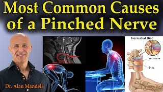 Most Common Causes of a Pinched Nerve  Dr Mandell [upl. by Halyak]