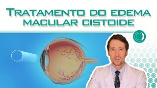 Tratamento do Edema Macular Cistóide [upl. by Archangel]