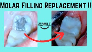 Can This Cracked Molar Be Saved Watch The Surprising Fix [upl. by Yrebmik]