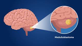 LateOnset Complications of Childhood Medulloblastoma [upl. by Hannahoj]