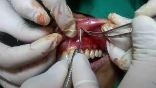 Gingival Recession Treatment  Acellular Dermal Matrix Membrane [upl. by Htilil7]