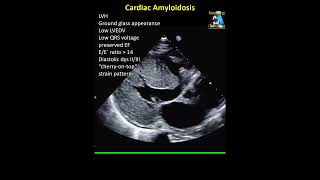 Cardiac Amyloidosis [upl. by Freddy]