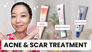 ACNE amp SCAR Treatment That Actually Works  Get Clear Skin Fast  KBeauty Over the Counter [upl. by Zashin379]