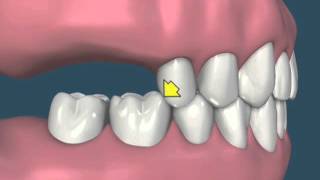 Perda dental e suas consequências  vídeo 2 [upl. by Meerak854]