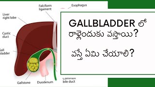 Gallbladder Stones Causes Symptoms and Treatment Options Explained gallstones [upl. by Burnsed]