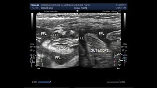 Ultrasound Video showing Intestinal obstruction with perforation [upl. by Nylasej]