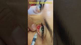 Chalazion treatment with steroid injection  Халязіон Інєкція стероїда [upl. by Saunderson]