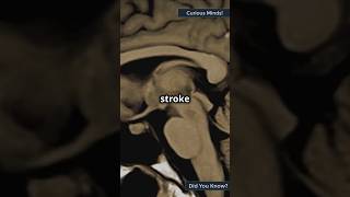 Recognizing the Warning Signs of a Stroke A LifeSaving Guide [upl. by Maccarone]