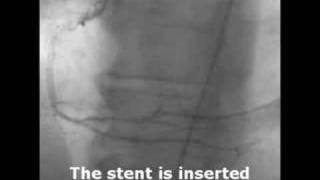 What A Diffenence A Stent Makes [upl. by Giglio]