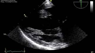 3 RUPTURE CHORDAE TRANSGASTRIC TOE VIEW MITRAL REGURGITATION [upl. by Obrien]