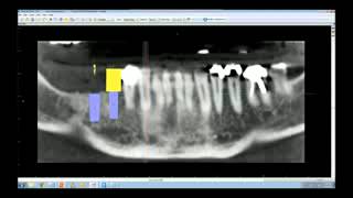 Future tooth position  the key to restorativedriven virtual implant planning 14 [upl. by Karney]