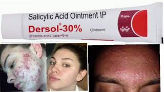 Dersol 30 Ointment Salicylic Acid Ointment IP [upl. by Gabi]