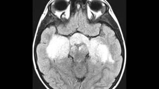 Optic Pathway Glioma [upl. by Akemed]