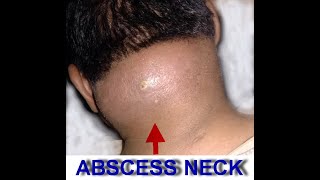 NECK ABSCESS 1 [upl. by Atinod]