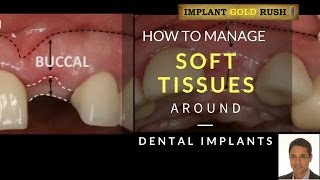 How to manage the soft tissue around implants [upl. by Toney]