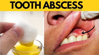 Fastest Way To Get Rid Of A Dental Abscess A Gum Abscess Without Going To The Dentist Antibiotics [upl. by Lenny]