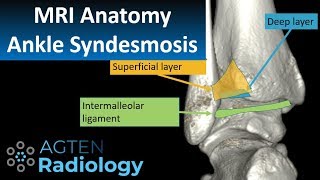 MRI Anatomy of Ankle Ligaments Syndesmosis [upl. by Adelbert513]