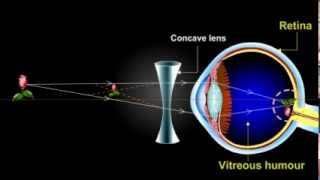 what is myopia Short Sightedness [upl. by Kirit]