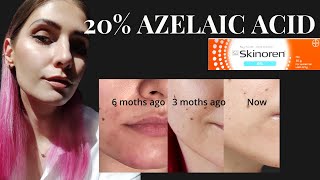 20 Azelaic Acid Skinoren cream for Pigmentation Melasma Rosacea amp Acne skinoren azelaicacid [upl. by Alejo]