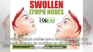 10 Home Remedies To Treat Swollen Lymph Nodes Naturally [upl. by Rexana]