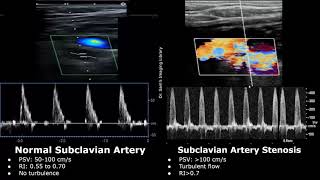 Subclavian Artery Doppler Ultrasound Normal Vs Abnormal Images  Stenosis amp Steal Syndrome USG [upl. by Sremmus]