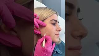 masseter botox plasticsurgery jawline shorts botox [upl. by Noired819]