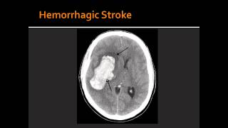 Atherosclerosis Hemorrhagic Stroke Ischemic Stroke amp Transient Ischemic Attack TIA [upl. by Amilah206]