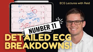 EKG Test Yourself  ECG Case Study 11 [upl. by Inesita130]