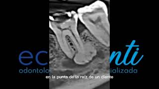 Cementoblastoma cementoma [upl. by Goeselt661]