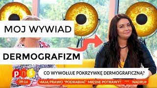 VLOG Pisanie po skórze w TV czyli Dermografizm [upl. by Suivatna]