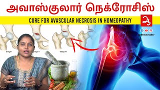 ரத்தஓட்டம் தடைபடுவதால் வரும் Avascular necrosis loss of blood supply to bone Avascular necrosis AVN [upl. by Priebe238]