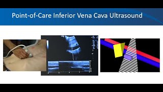 Renal ultrasound video 3 Volume status University of Florida Nephrology Dr Koratala NephroP [upl. by Boswall]