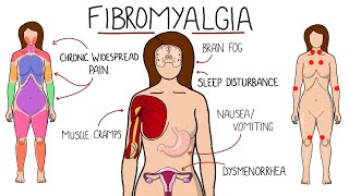 Fibromyalgia  A Chronic Pain Disorder Includes Symptoms Criteria amp Treatment Options [upl. by Nalor]