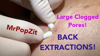 Deep clogged pores on the back extracted Blackhead removal up close by the dozens [upl. by Hennie]