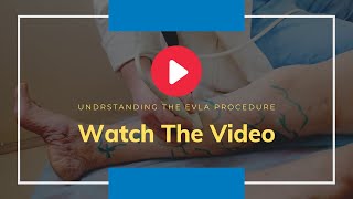 Say Goodbye to Varicose Veins EVLT Minimally Invasive Surgery Explained [upl. by Dorree]