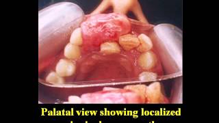 Surgical Excision of Localized Gingival Overgrowthavi [upl. by Ailicec]