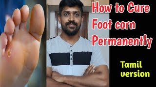 கால் ஆணி Foot Corn  கால் ஆணி செரியாக permanent cure  Tamil  Lohisya media [upl. by Bunce]