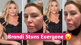 RHOBH Brandi Glanville showed off her disfigured face in a shocking new photo claiming Bravo [upl. by Htomit]