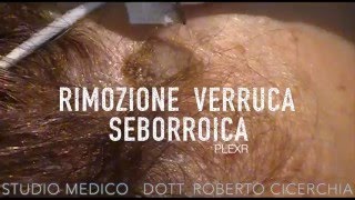 Rimozione Cheratosi con PLEXR  Dott Roberto Cicerchia [upl. by Daile]