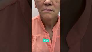 FACELIFT ONEWEEK POSTOP  DR TANVEER JANJUA NEW JERSEY [upl. by Assek667]