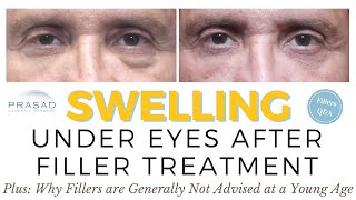 Possible Causes and Treatment of Swelling Under the Eyes with Cosmetic Fillers [upl. by Enilrac]