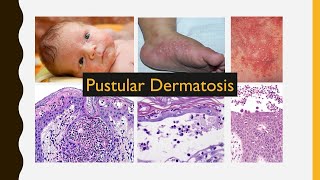 6 Pustular Dermatosis [upl. by Gathers]