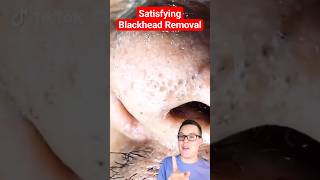 Crazy BLACKHEAD REMOVAL  Blackhead Extraction shorts [upl. by Enajiram]