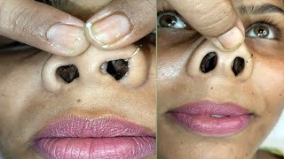 Nose hair cutting and nose massagenosePignosehaircutting piggynosemassage pummybeautyworld [upl. by Nawj134]