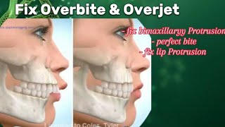 Fix Overbite amp BiMaxillary Protrusion Fix   Subliminal virtual orthodontics treatment [upl. by Akinihs979]