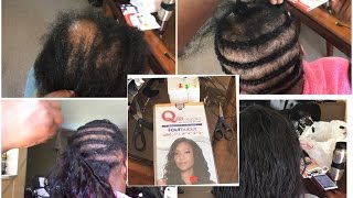 ALOPECIA COVERED SEW IN QUE BY MILKYWAY FOURBULOUS VANILLA WEAVE [upl. by Robinet]