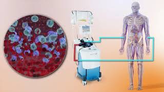 Autologous Stem Cell Transplant Timeline Procedure and Recovery [upl. by Adley644]