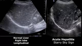 Liver Ultrasound Normal Vs Abnormal Image Appearances Comparison  Liver Ultrasound Pathologies [upl. by Smiley93]