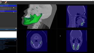 Deep learning based CT Segmentation mandible Demo [upl. by Ramirolg]